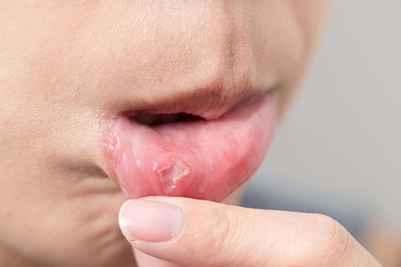 Afte: cosa sono e come rimediare